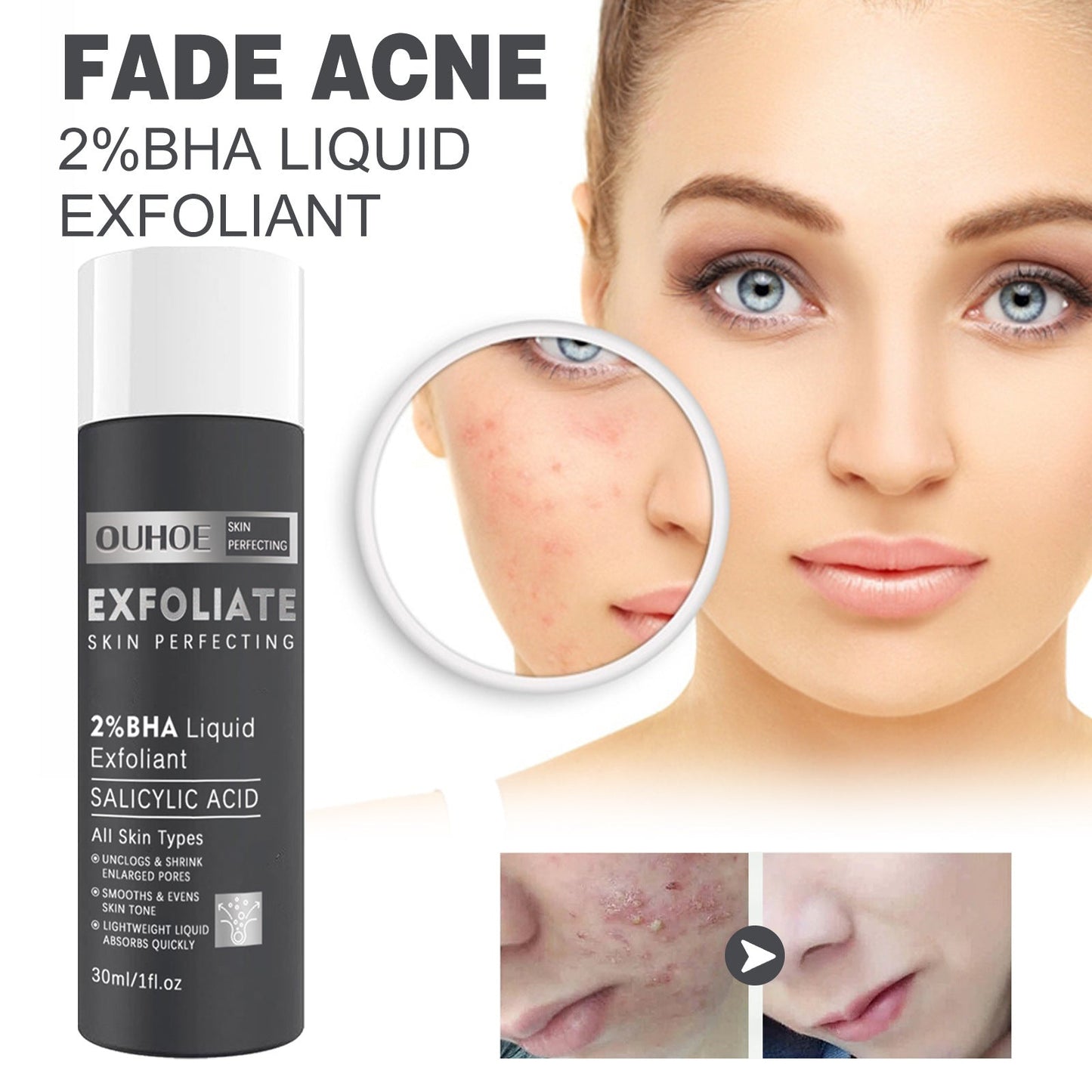 Salicylate Acne Treatment Hydrating Skin Solution